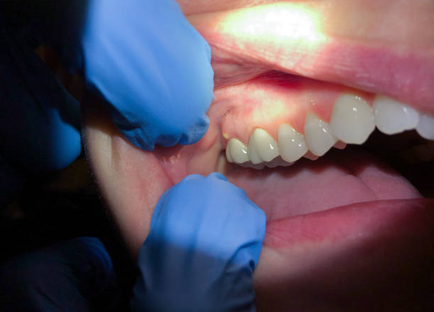 Best Emergency Treatment for Oral Infections in Port Aransas, TX