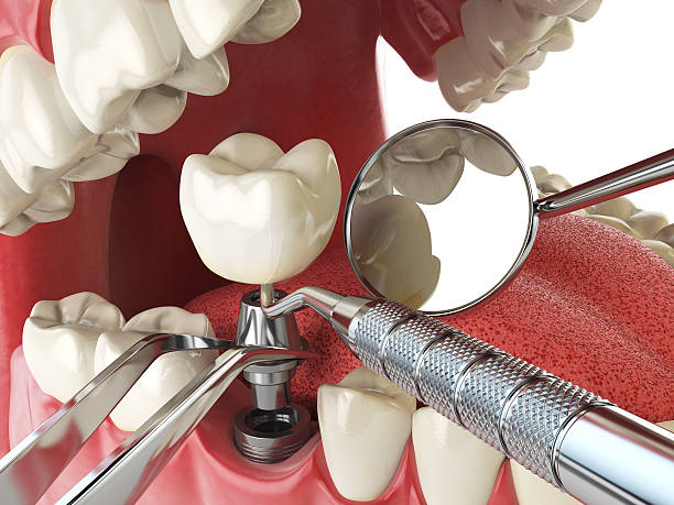 Best Emergency Denture Repair in Port Aransas, TX